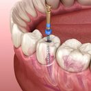 Endodontinis gydymas