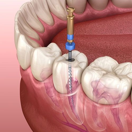 Dantų kanalų gydymas rotaciniais instrumentais