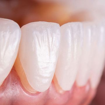 Estetinis dantų atkūrimas: greitai ir be skausmo
